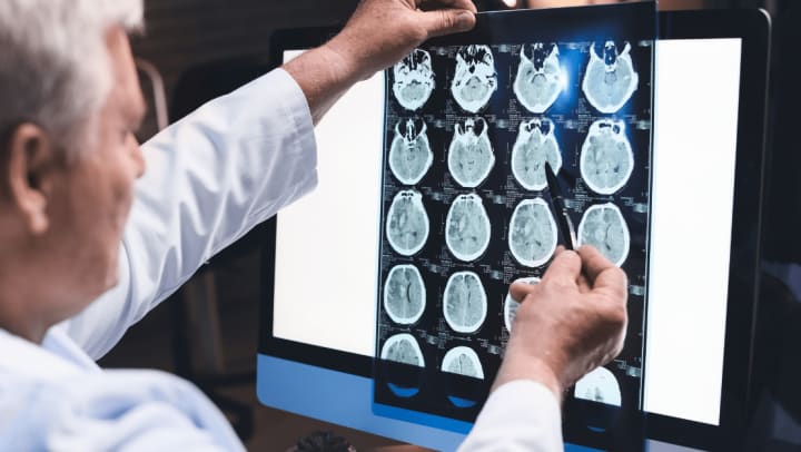 Alzheimer
